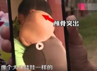 “大头娃娃”为何再现 有些人赚着奶粉钱却卖着毒药